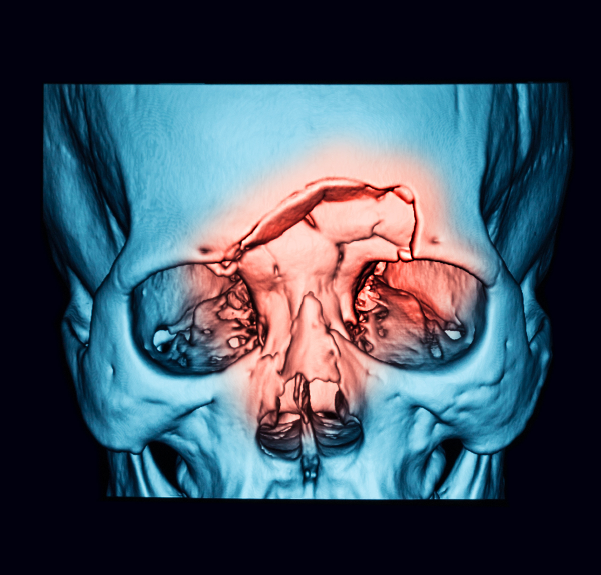 Orbital Fracture